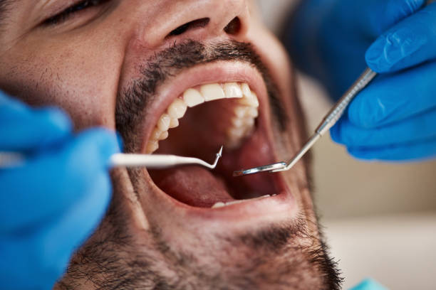 Best Emergency Wisdom Tooth Extraction in Marillo, CA