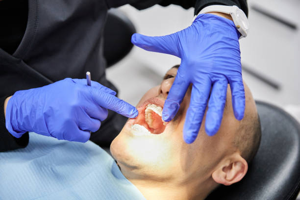 Best Emergency Wisdom Tooth Extraction in Marillo, CA